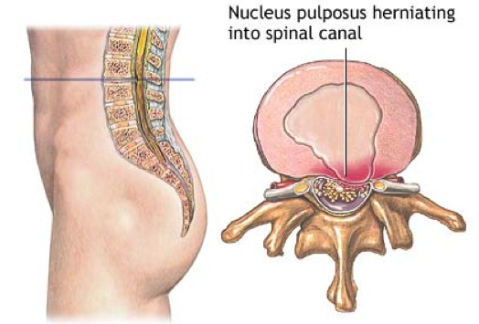 What are the symptoms of lumbar disc herniation?