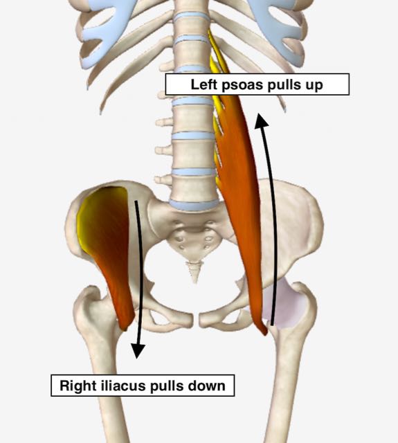 Right iliacus and left psoas both locked short.