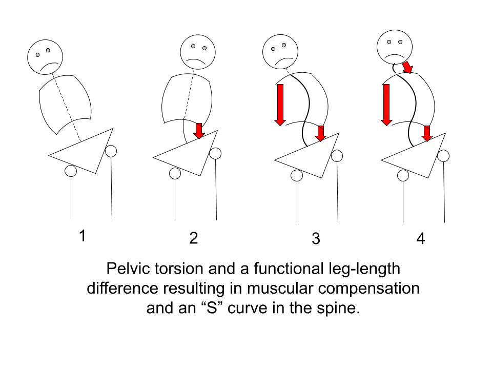 Pelvic torsion causing a functional S-Curve in the spine.