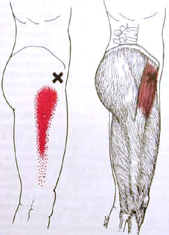 Upper Back, Shoulder, and Arm  The Trigger Point & Referred Pain