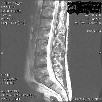 exercises grade retrolisthesis 1 for Surgical Out of Running Non Options exercises grade retrolisthesis 1 for Surgical Out of Running Non Options